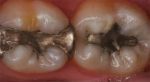 wypełnienie zębów amalgamatem