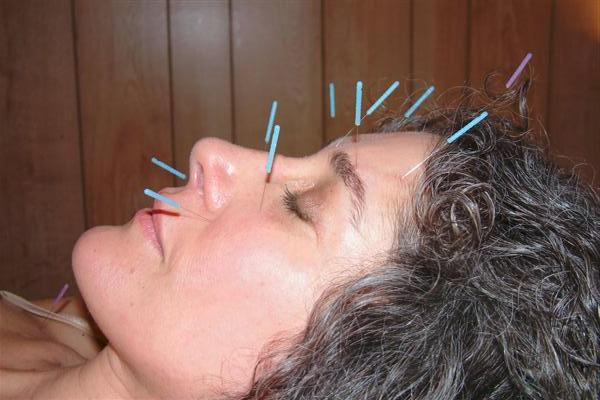 akupunktura w praktyce